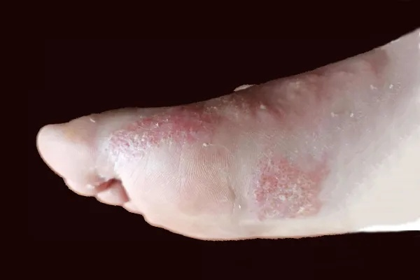 脚上怎样分辨是湿疹还是脚气(脚上怎么分辨是湿疹还是疱疹) 脚上怎样分辨是湿疹还是脚气(脚上怎么分辨是湿疹还是疱疹)